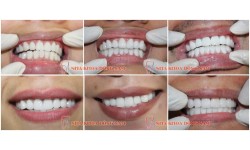 Bọc răng sứ thẩm mỹ với quy trình đúng chuẩn quốc tế
